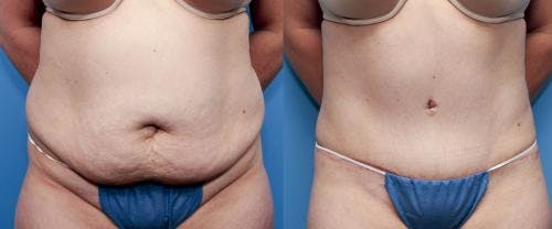 Tummy Tuck Before & After Gallery - Patient 58470129 - Image 1