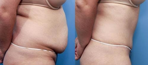 Tummy Tuck Before & After Gallery - Patient 58470129 - Image 2