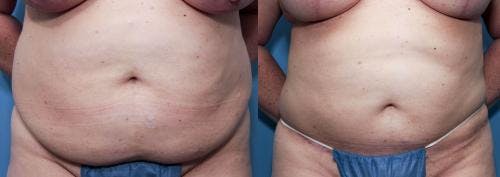 Tummy Tuck Before & After Gallery - Patient 58470130 - Image 1