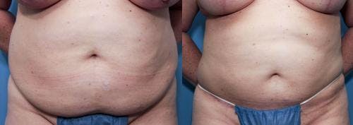 Tummy Tuck Before & After Gallery - Patient 58470130 - Image 1