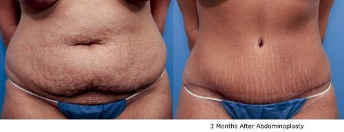 Tummy Tuck Before & After Gallery - Patient 58470131 - Image 1