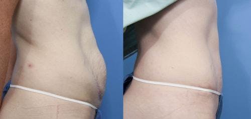 Tummy Tuck Before & After Gallery - Patient 58470136 - Image 2