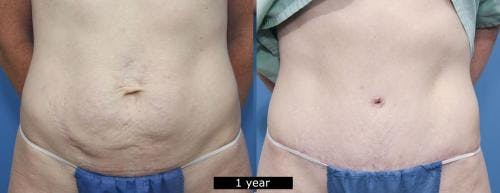 Tummy Tuck Before & After Gallery - Patient 58470136 - Image 1