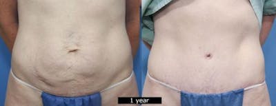 Tummy Tuck Before & After Gallery - Patient 58470136 - Image 1