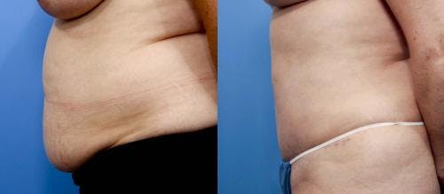Tummy Tuck Before & After Gallery - Patient 58470174 - Image 2