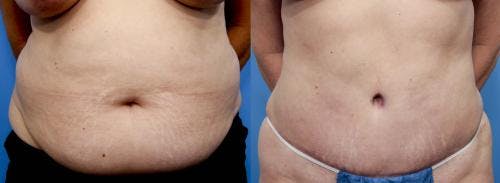 Tummy Tuck Before & After Gallery - Patient 58470174 - Image 1
