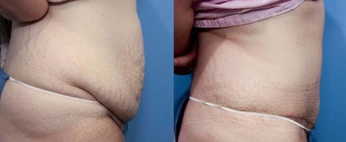 Tummy Tuck Before & After Gallery - Patient 58470175 - Image 2