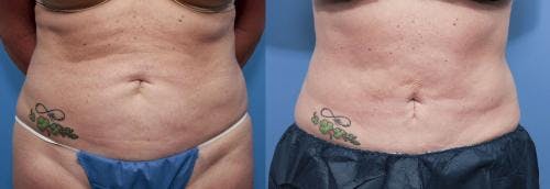 Tummy Tuck Before & After Gallery - Patient 58470176 - Image 1