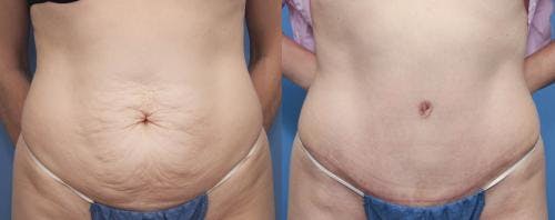Tummy Tuck Before & After Gallery - Patient 58470177 - Image 1