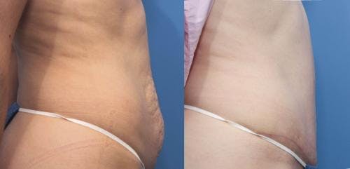 Tummy Tuck Before & After Gallery - Patient 58470177 - Image 2