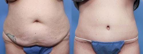 Tummy Tuck Before & After Gallery - Patient 58470178 - Image 1