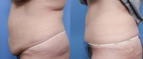 Tummy Tuck Before & After Gallery - Patient 58470178 - Image 2