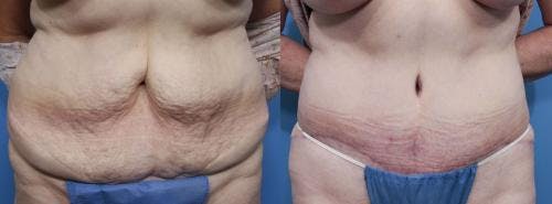 Tummy Tuck Before & After Gallery - Patient 58470179 - Image 1