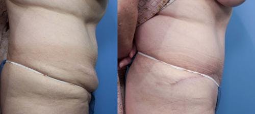 Tummy Tuck Before & After Gallery - Patient 58470179 - Image 2