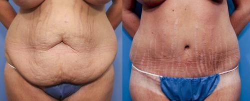 Tummy Tuck Before & After Gallery - Patient 58470180 - Image 1