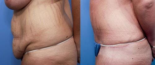 Tummy Tuck Before & After Gallery - Patient 58470180 - Image 2