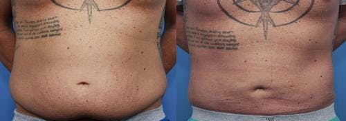Tummy Tuck Before & After Gallery - Patient 58470181 - Image 1