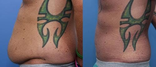 Tummy Tuck Before & After Gallery - Patient 58470181 - Image 2
