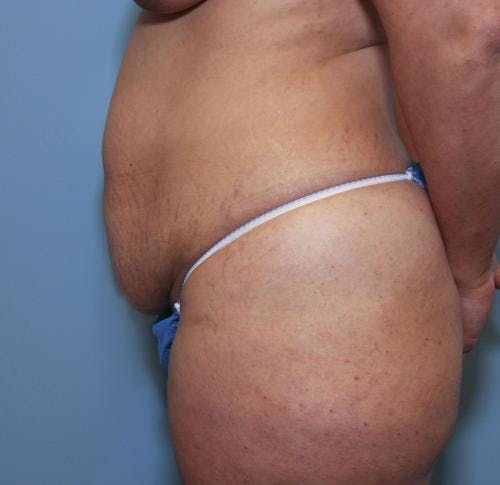 Tummy Tuck Before & After Gallery - Patient 58470185 - Image 3
