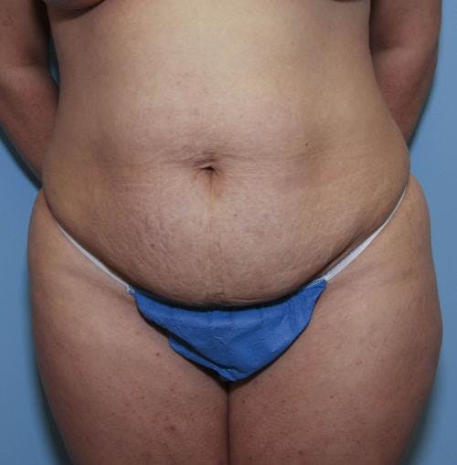 Tummy Tuck Before & After Gallery - Patient 58470185 - Image 1
