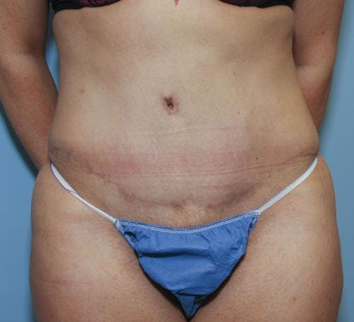 Tummy Tuck Before & After Gallery - Patient 58470185 - Image 2