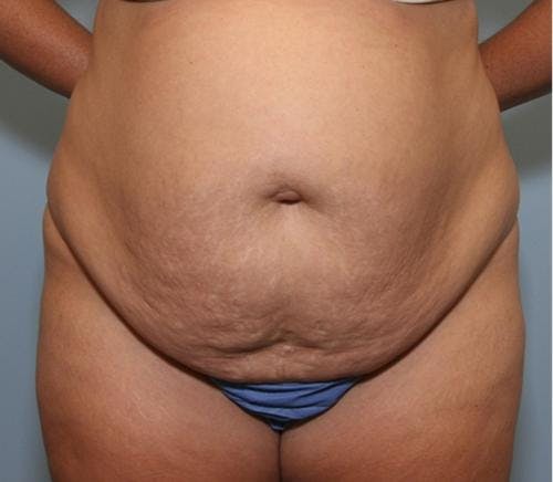 Tummy Tuck Before & After Gallery - Patient 58470186 - Image 1