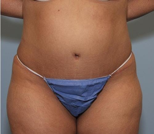 Tummy Tuck Before & After Gallery - Patient 58470186 - Image 2