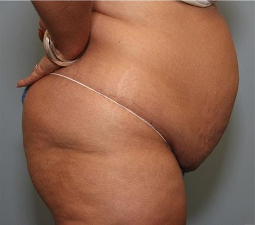 Tummy Tuck Before & After Gallery - Patient 58470186 - Image 3