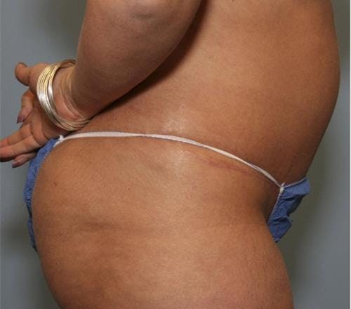 Tummy Tuck Gallery - Patient 58470186 - Image 4