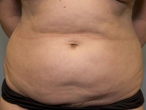 Tummy Tuck Before & After Gallery - Patient 58470187 - Image 1