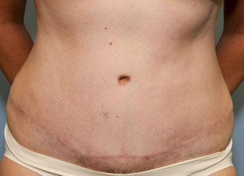 Tummy Tuck Before & After Gallery - Patient 58470187 - Image 2
