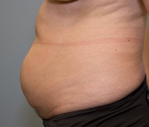 Tummy Tuck Before & After Gallery - Patient 58470187 - Image 3