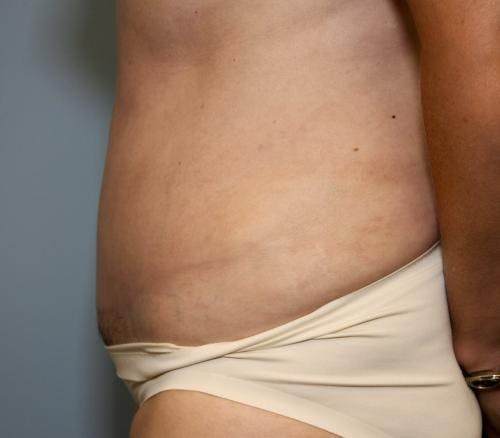 Tummy Tuck Before & After Gallery - Patient 58470187 - Image 4