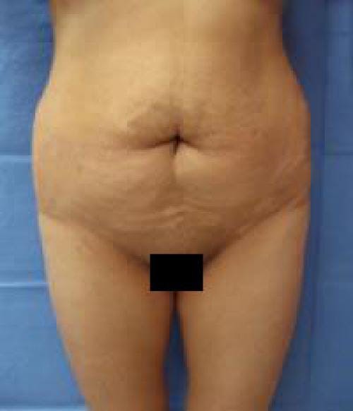 Tummy Tuck Before & After Gallery - Patient 58470200 - Image 1