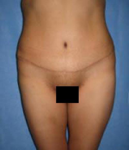 Tummy Tuck Before & After Gallery - Patient 58470200 - Image 2