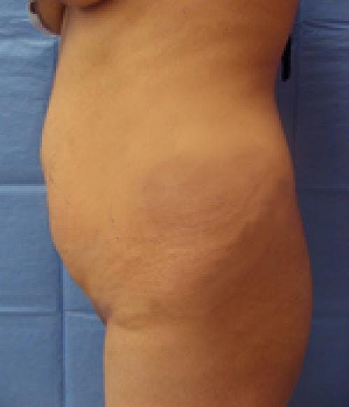 Tummy Tuck Before & After Gallery - Patient 58470200 - Image 3