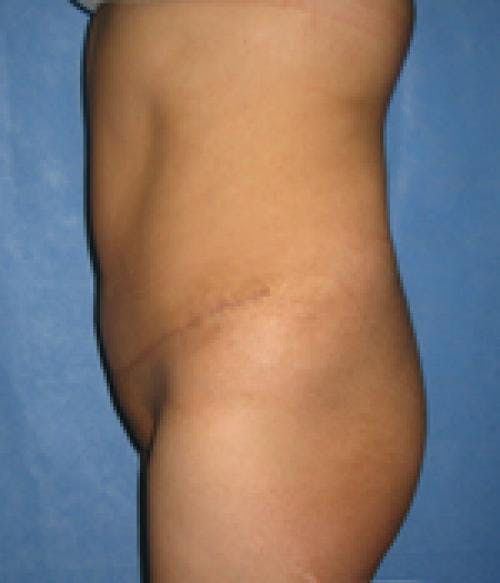 Tummy Tuck Before & After Gallery - Patient 58470200 - Image 4