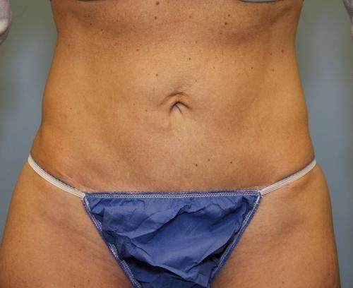 Tummy Tuck Before & After Gallery - Patient 58470202 - Image 2