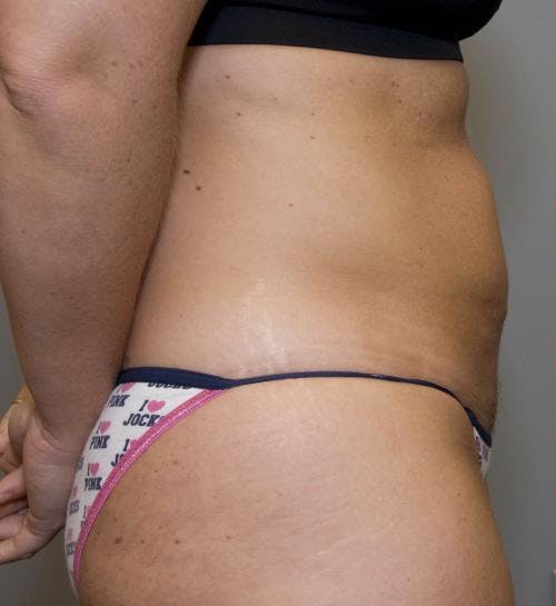Tummy Tuck Before & After Gallery - Patient 58470202 - Image 3