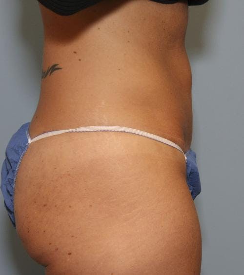 Tummy Tuck Before & After Gallery - Patient 58470202 - Image 4