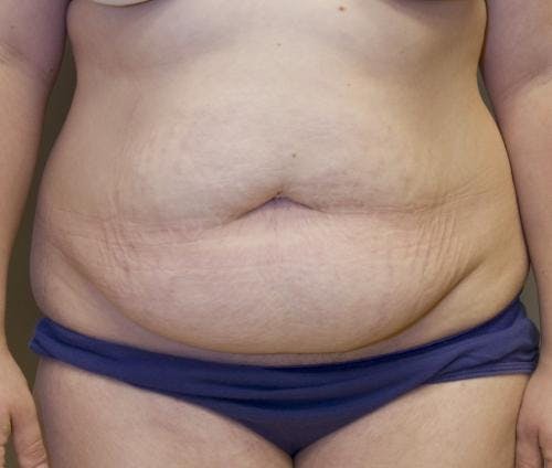 Tummy Tuck Before & After Gallery - Patient 58470204 - Image 1
