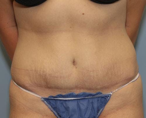 Tummy Tuck Before & After Gallery - Patient 58470204 - Image 2