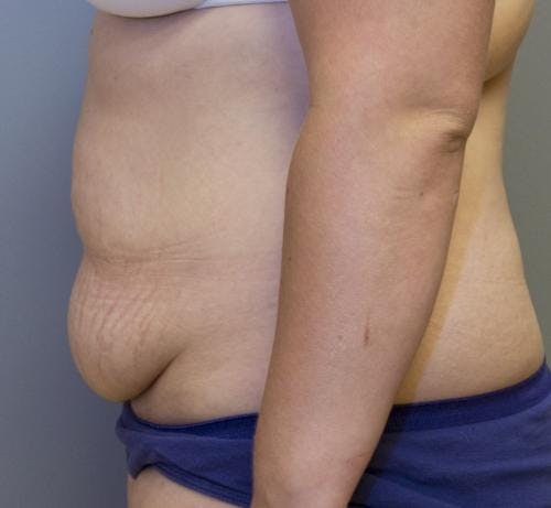 Tummy Tuck Before & After Gallery - Patient 58470204 - Image 3