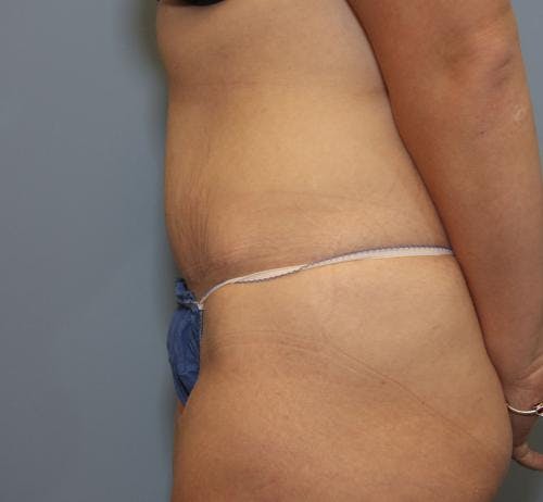 Tummy Tuck Before & After Gallery - Patient 58470204 - Image 4