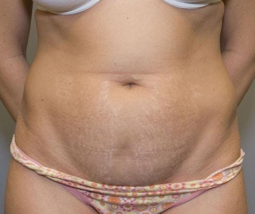 Tummy Tuck Before & After Gallery - Patient 58470206 - Image 1