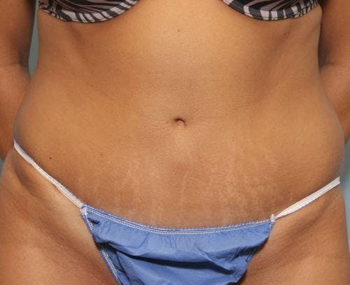 Tummy Tuck Before & After Gallery - Patient 58470206 - Image 2