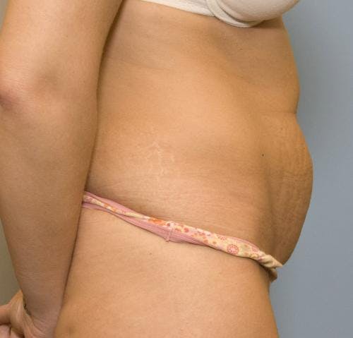 Tummy Tuck Before & After Gallery - Patient 58470206 - Image 3