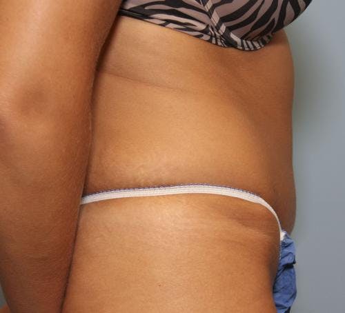 Tummy Tuck Gallery - Patient 58470206 - Image 4