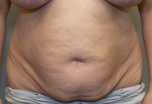 Tummy Tuck Before & After Gallery - Patient 58470207 - Image 1