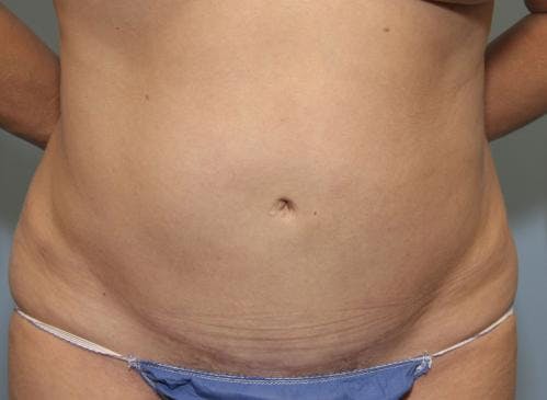 Tummy Tuck Before & After Gallery - Patient 58470207 - Image 2
